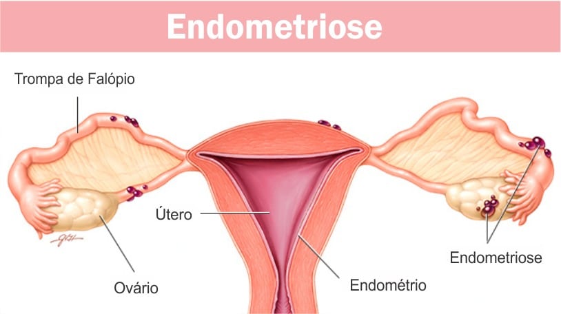 endometriose fotos