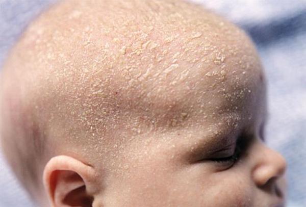 Bebê com dermatite seborréica (foto: Divulgação)