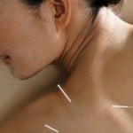 Conheça a acupuntura para o aleitamento