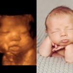 23 imagens de bebês antes e depois do ultrassom 3D
