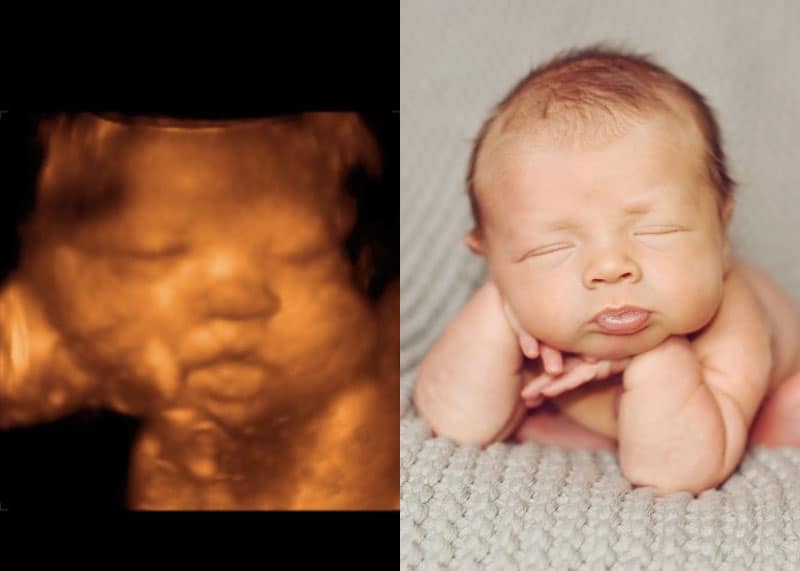 Read more about the article 23 imagens de bebês antes e depois do ultrassom 3D