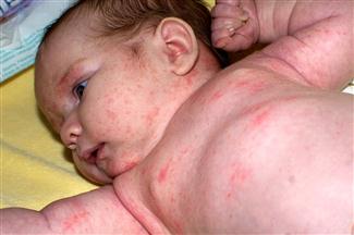 Bebê com intolerância a lactose (foto: Divulgação)
