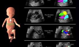 Ecocardiograma Fetal: O que é e quando fazer?
