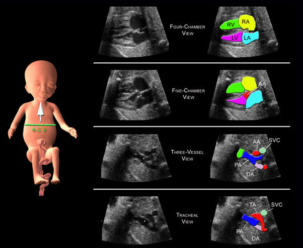 Read more about the article Ecocardiograma Fetal: O que é e quando fazer?