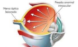 Glaucoma durante a gestação, o que fazer?