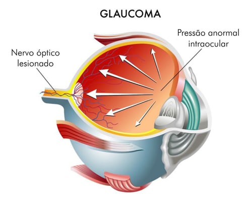 Read more about the article Glaucoma durante a gestação, o que fazer?