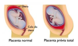 Placenta prévia na gestação – Cuidados, Tratamento