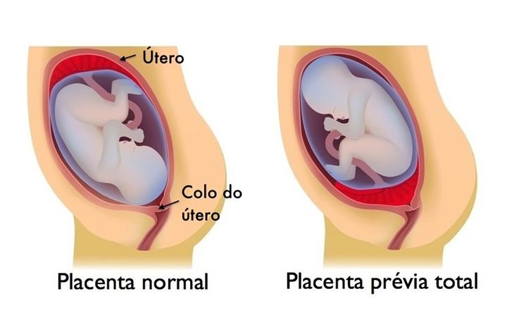 Read more about the article Placenta prévia na gestação – Cuidados, Tratamento