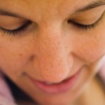 Melasma na gravidez – Como evitar, tratamento