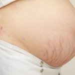 Estrias vermelhas na gravidez – Há tratamento? Tem cura?