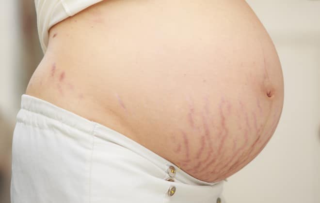 Read more about the article Estrias vermelhas na gravidez – Há tratamento? Tem cura?