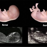 Translucência Nucal: quais os valores normais?