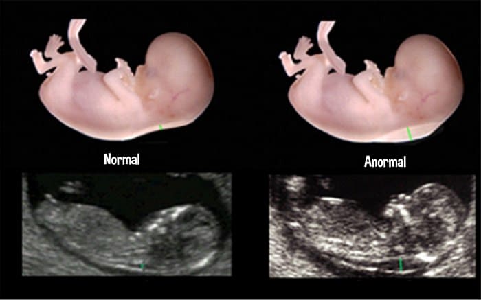 Read more about the article Translucência Nucal: quais os valores normais?