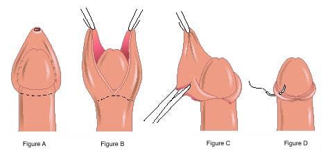 cirurgia fimose