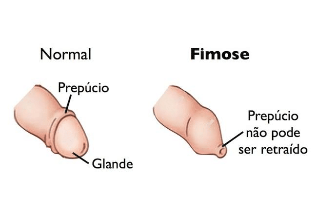 fimose no bebê