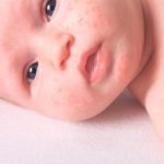 Tratamento para acne neonatal