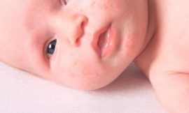 Tratamento para acne neonatal