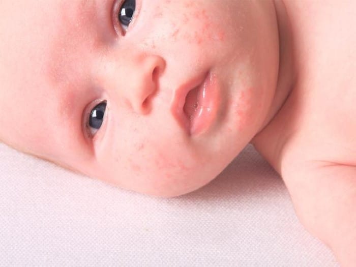 acne neonatal sintomas