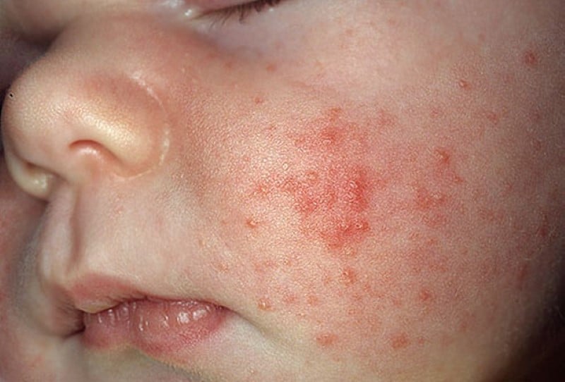  acne neonatal tratamento