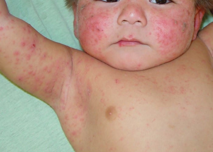 Acne neonatal