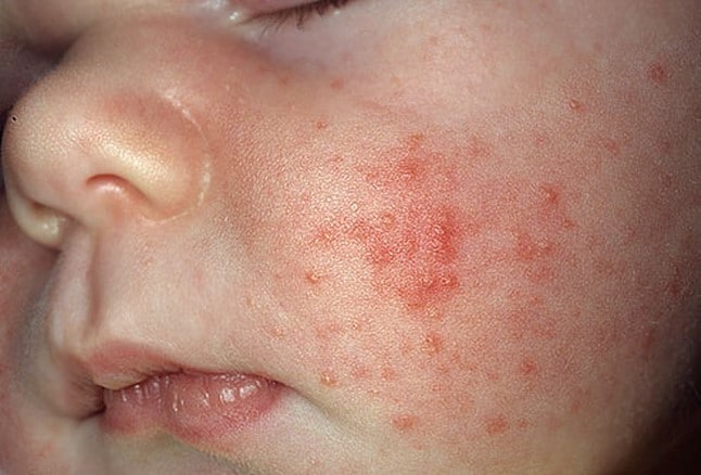 acne neonatal como tratar