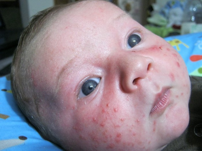 acne neonatal fotos