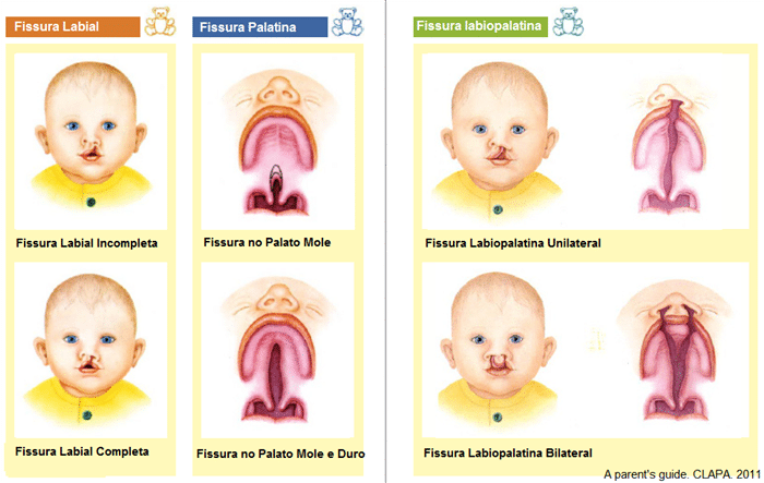 fenda palatina consequencias