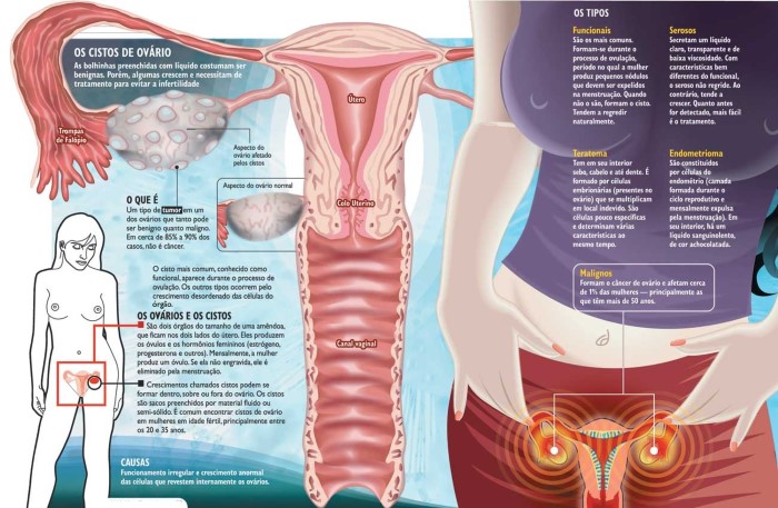 cisto no ovario pode ser confundido com gravidez 