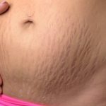 Coçar a barriga durante a gravidez dá estrias?