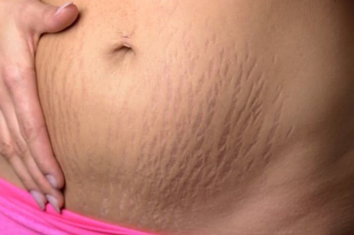 Read more about the article Coçar a barriga durante a gravidez dá estrias?