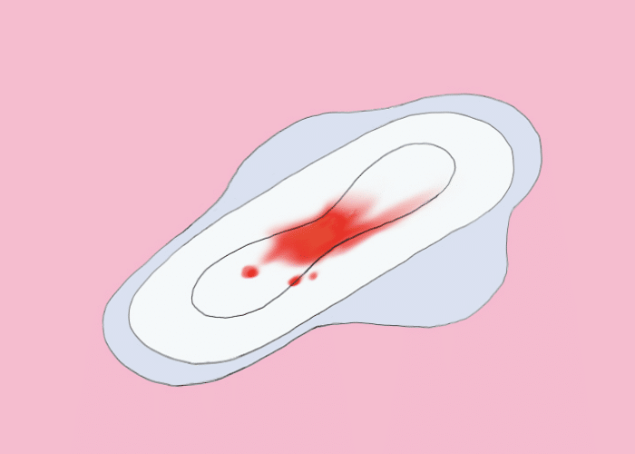 Nidação ou Menstruação: Como diferenciar 