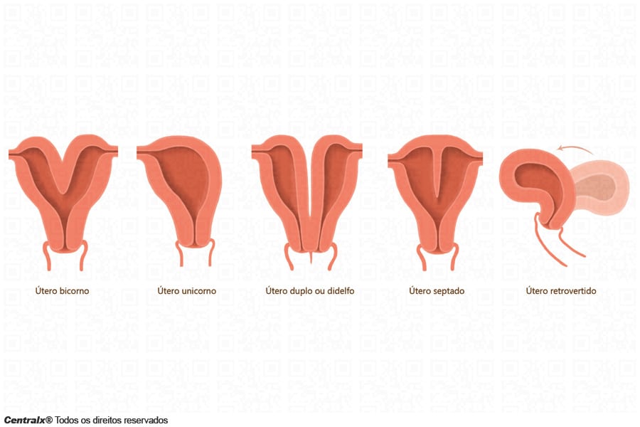 utero bicorno sintomas