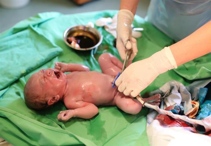 como cortar o cordão umbilical de um recem nascido