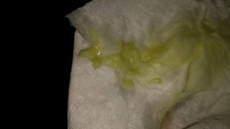 Corrimento verde na gravidez é normal?