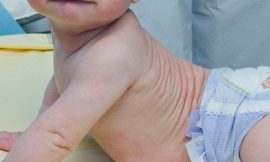 Dermatite de contato no bebê: Como tratar