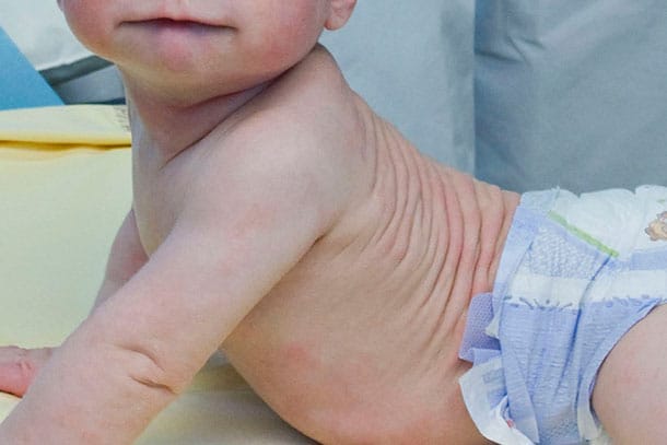 Read more about the article Dermatite de contato no bebê: Como tratar
