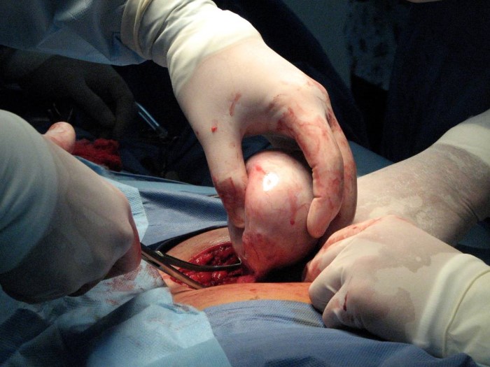 teratoma fotos tratamentos para teratoma