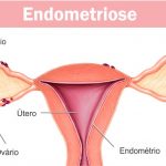 Endometriose: causas, sintomas, diagnóstico, tratamento e recuperação