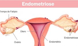 Endometriose: causas, sintomas, diagnóstico, tratamento e recuperação