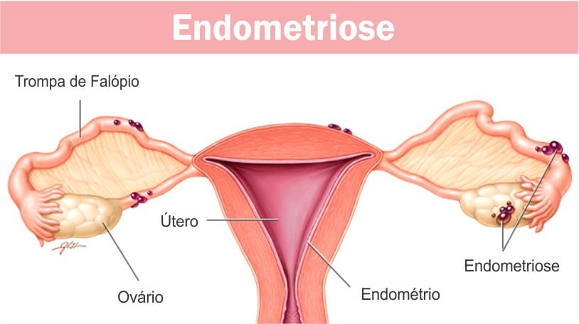 Read more about the article Endometriose: causas, sintomas, diagnóstico, tratamento e recuperação