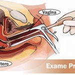 Exame Preventivo: Como é feito, para que serve, quando fazer, dói?