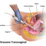 Ultrassom Transvaginal: para que serve, como é feito, preço médio