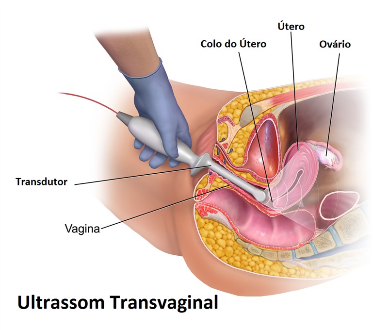 exame ultrassom transvaginal