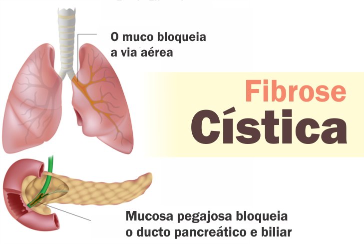 fibrose cistica fotos