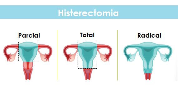 Histerectomia 