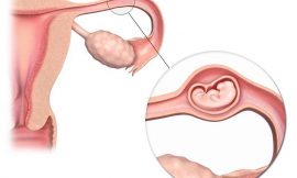 Gravidez nas Trompas: o que fazer, como descobrir, sintomas, cuidados e tratamento