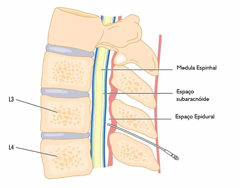 anestesia epidural com sedação