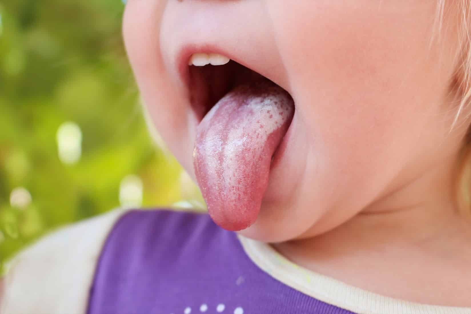 Sapinho Em Bebe O Que E Sintomas Como Tratar E Remedio Caseiro