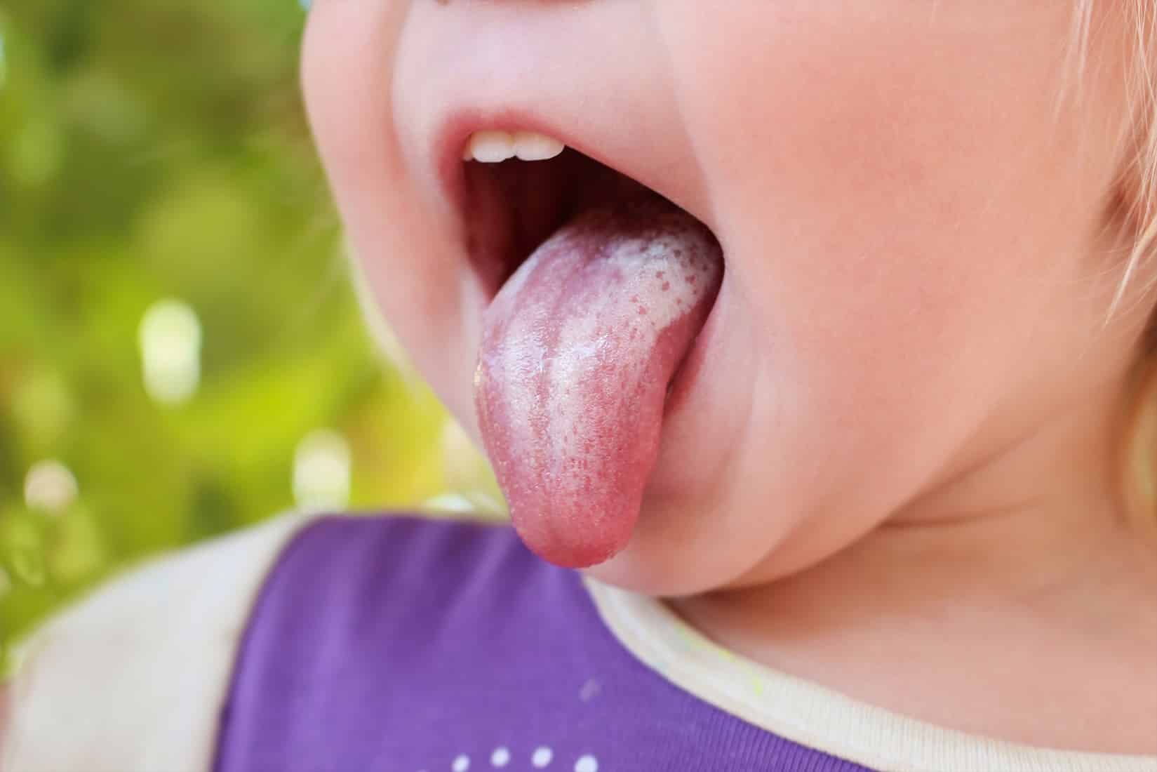 lingua do bebe com sapinho