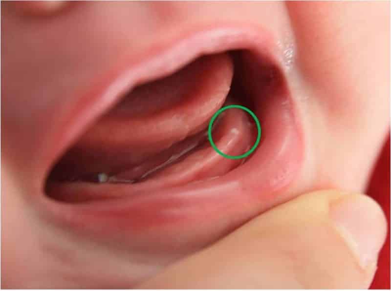 sintomas do nascimento dos dentes